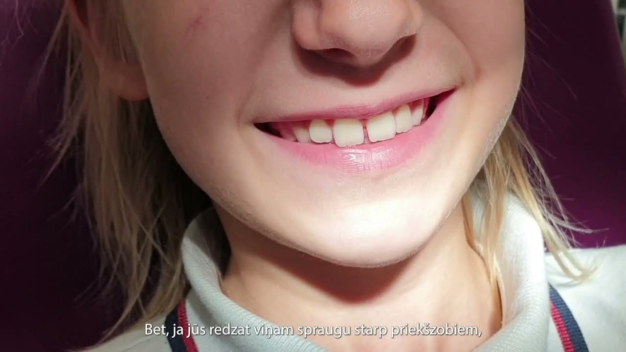 Lūpas saitītes operācija ar Fotona Nd/Yag Lāzeri.