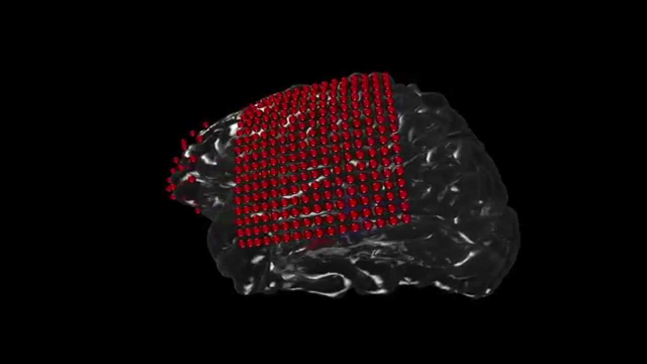 3D Reconstruction of ECoG Implanted Electrodes For Epilepsy Monitoring