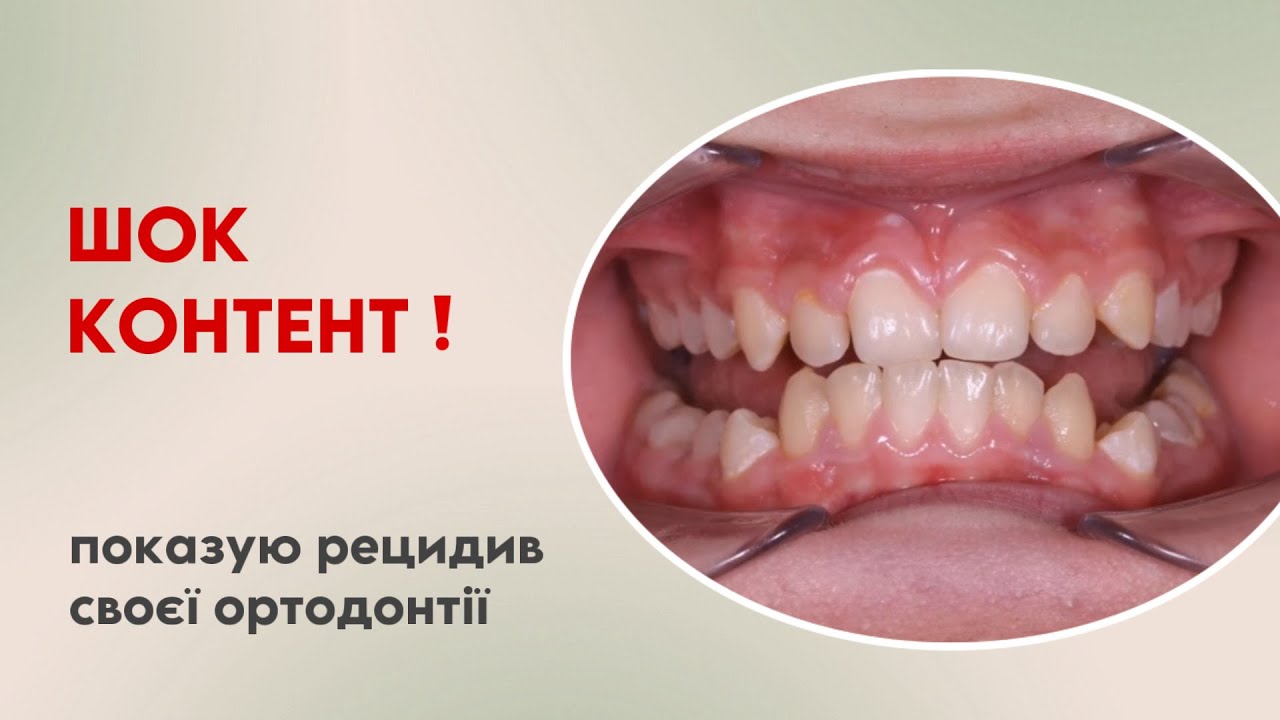 ШОК-КОНТЕНТ| РЕЦЕДИВ СВОЄЇ ОРТОДОНТІЇ | Б.Свінціцький | Ортодонт та Гнатолог