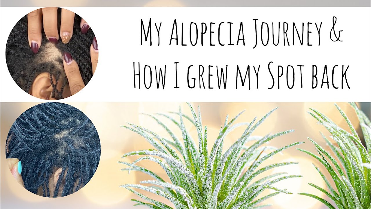 My Alopecia Journey, and How I Treated my Hair Loss While Having DIY Microlocs