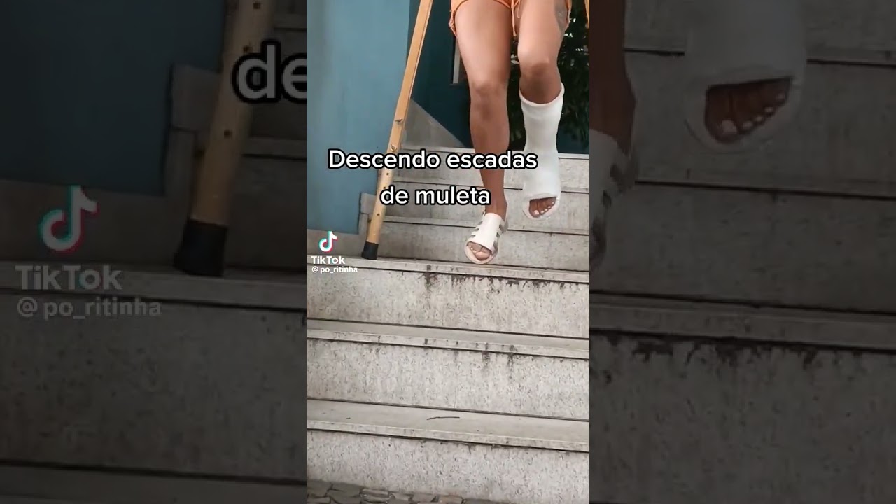 Enyesada escayolada Engessada Short Leg cast woman