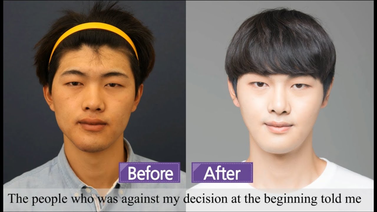 Rhinoplasty Nose Job + square jaw reduction + genioplasty + Endoforehead lifting