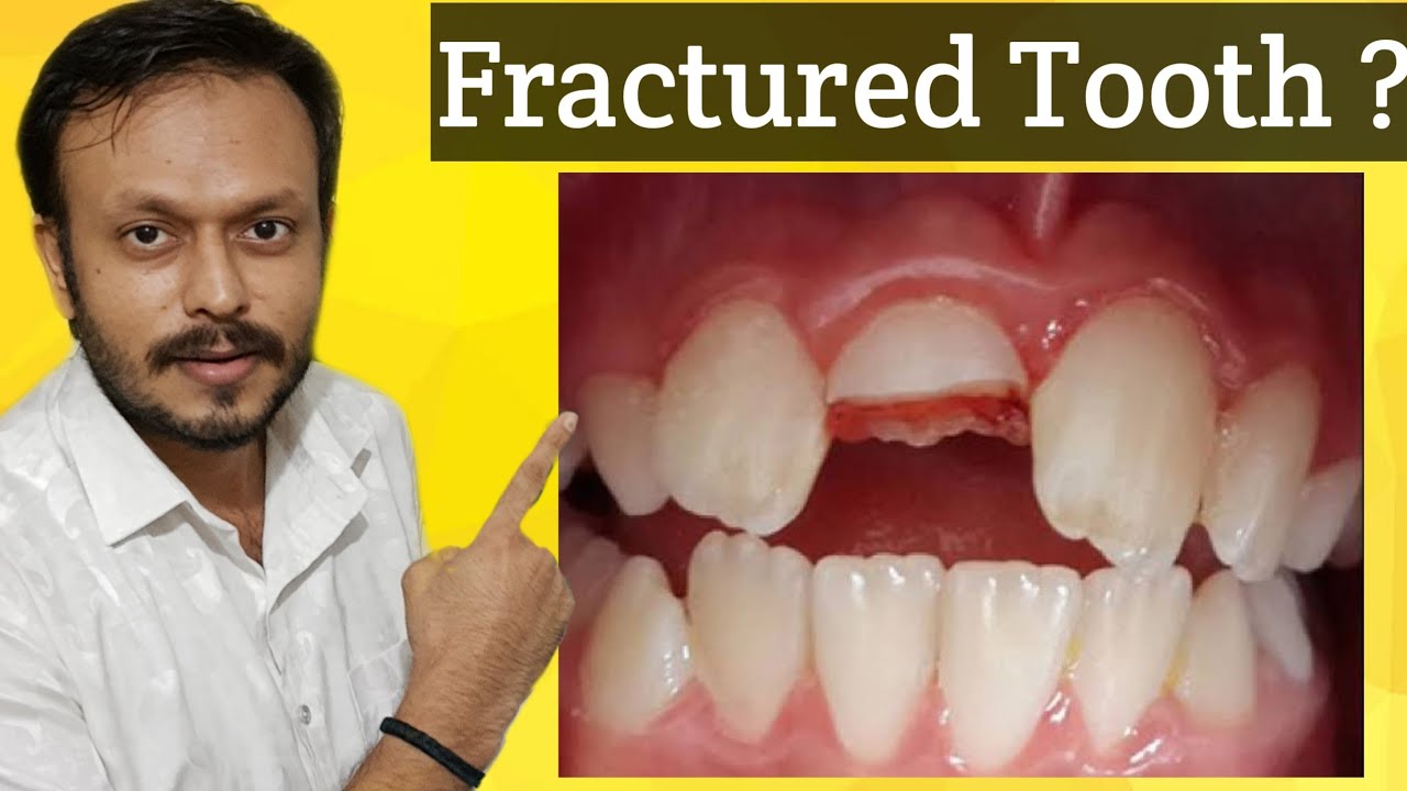 दाँत टूट गया ? Fractured tooth - What do I do now| Tooth crack in hindi | fracture tooth treatment