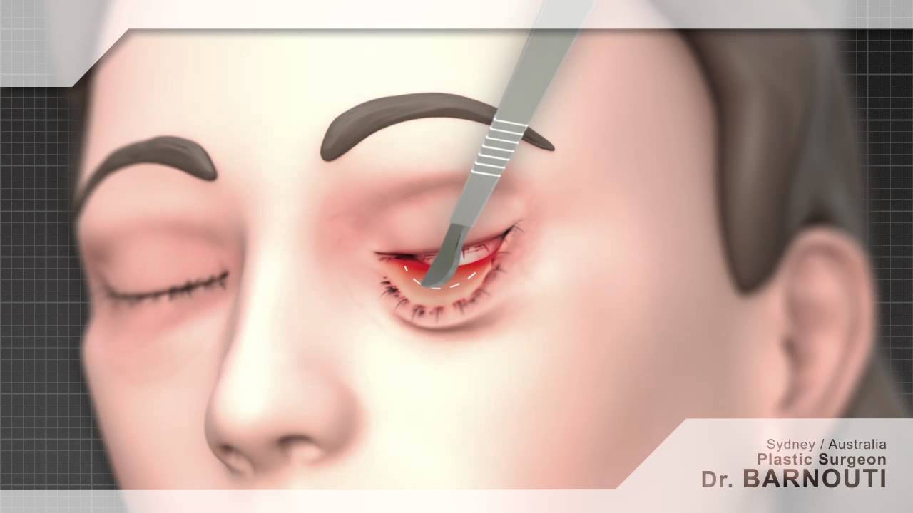 Cosmetic Surgery Animated Video | Eyelid Surgery