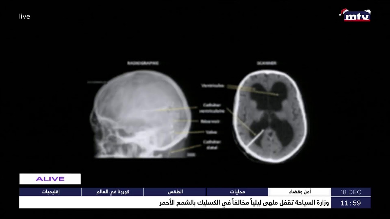 Sante – الاستسقاء الدماغي - د. جان الحاج