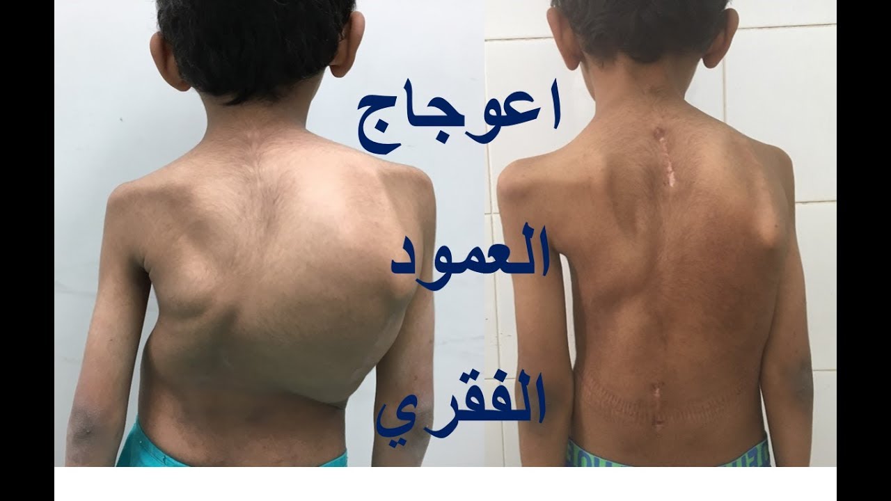طرق علاج اعوجاج العمود الفقري مبكّر الحدوث في الأطفال