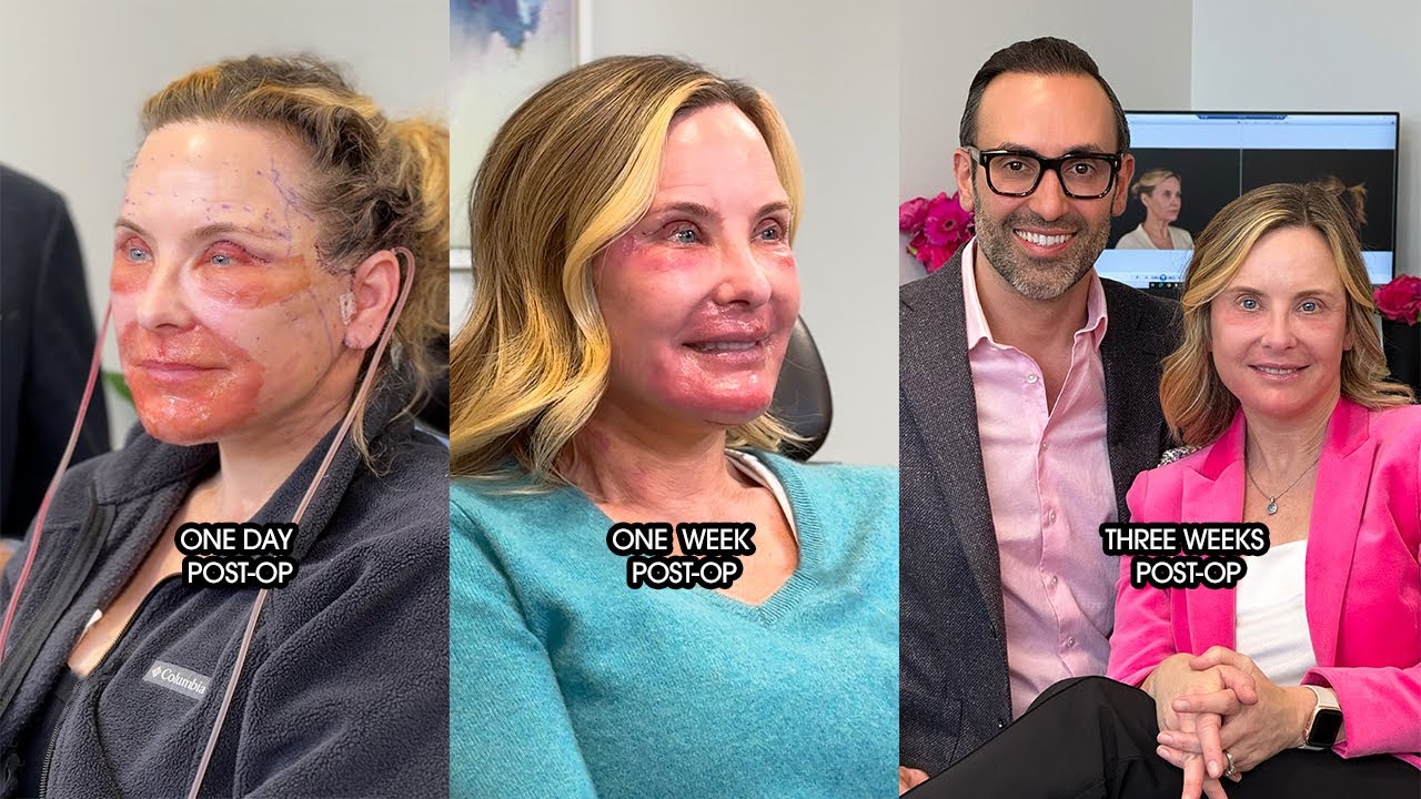 Three Weeks After Deep Plane Face & Neck Lift with Dr. Kian