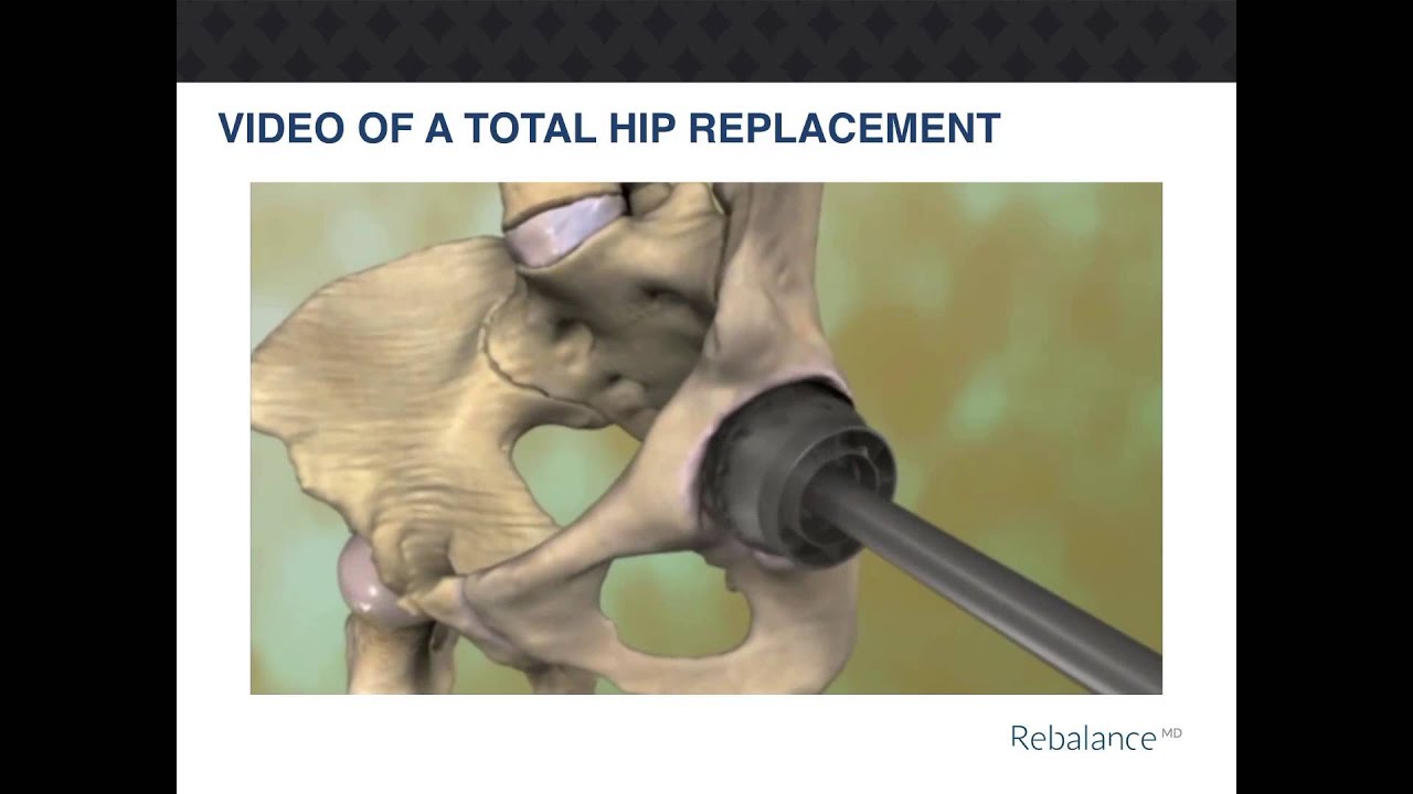RebalanceMD Total Hip Replacement