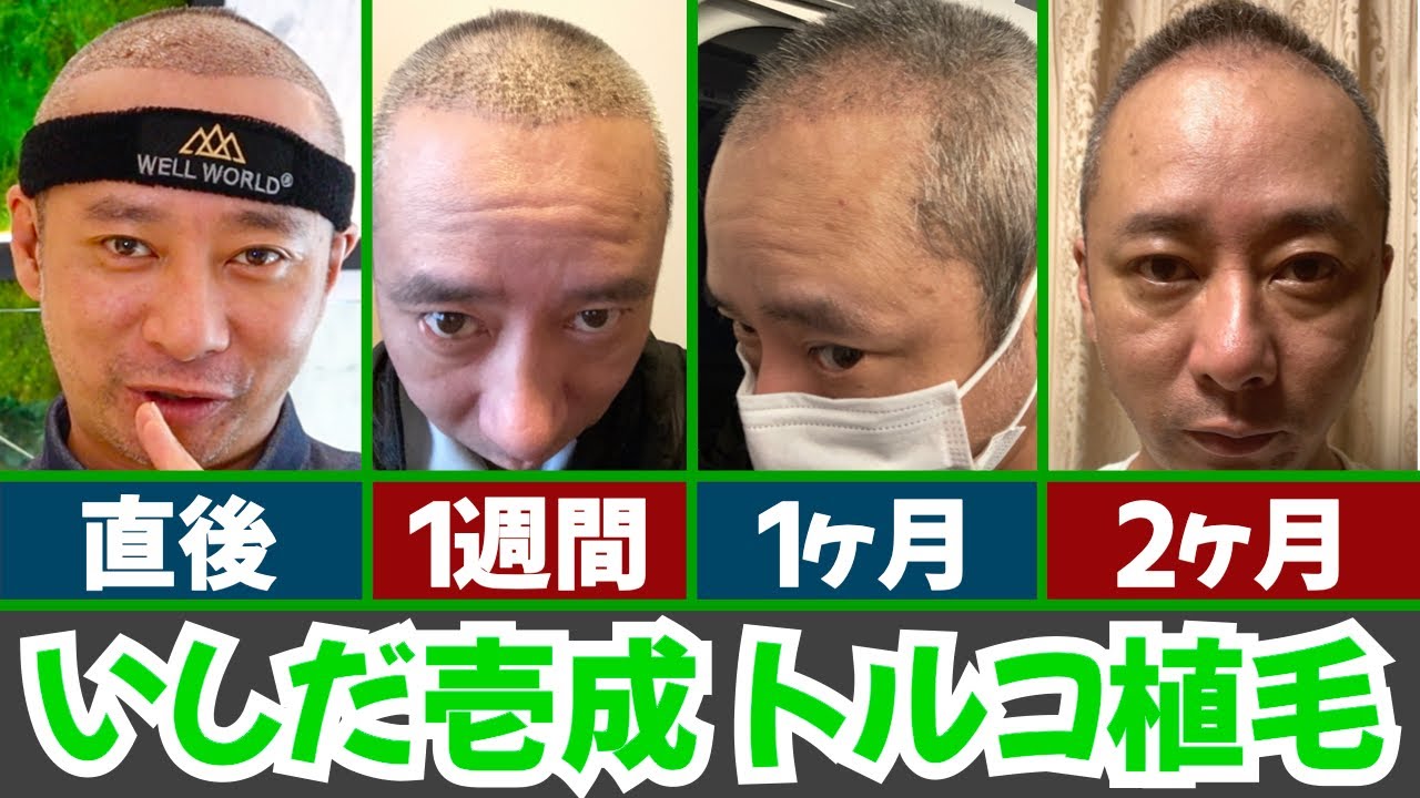 【芸能人】いしだ壱成 トルコ植毛 2ヶ月後までの経過【植毛大使｜治療｜薄毛の窓口】