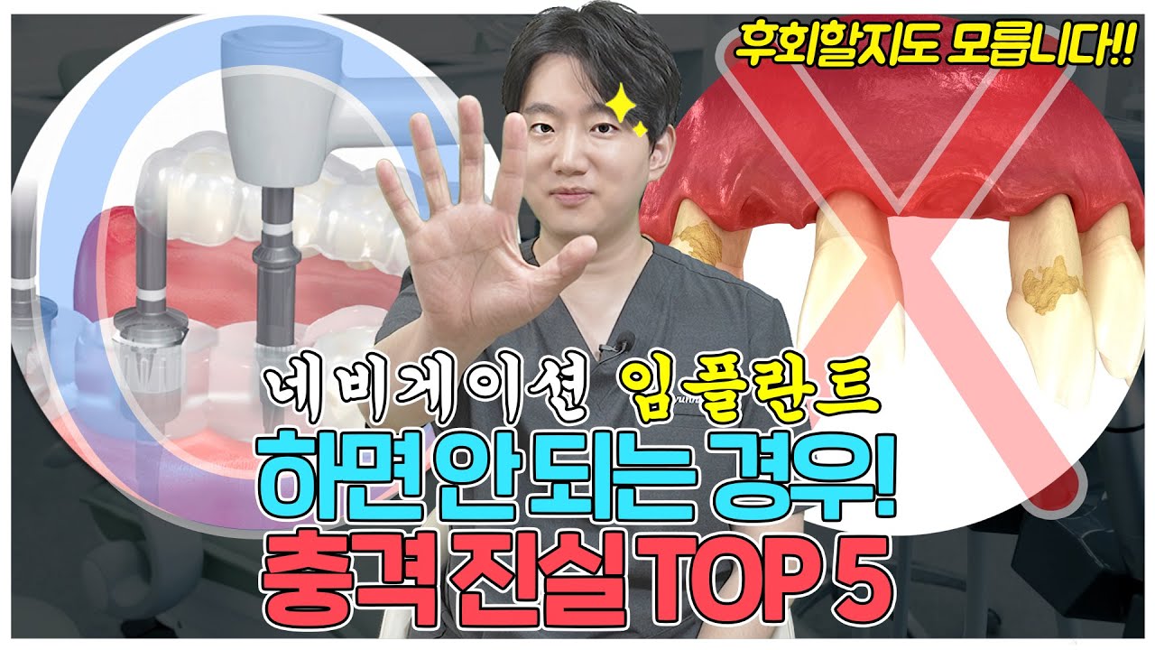 🦷네비게이션 임플란트는 광고처럼 장점만 있을까?🦷 l 네비게이션 임플란트의 충격적인 진실 TOP 5