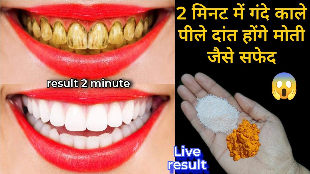 सिर्फ 2 मिनट में पीले गंदे दांतों को मोती की तरह चमका देगा यह घरेलू नुस्खा / Teeth whitening remedy
