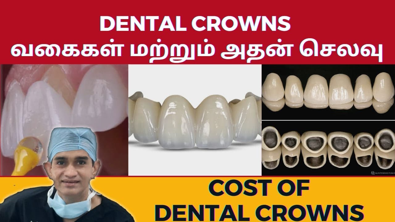 Cost of Dental Crowns | வகைகள் மற்றும் செலவு எவ்வளவு ஆகும் | Dr Arunkumar | Dental Clinic Chennai
