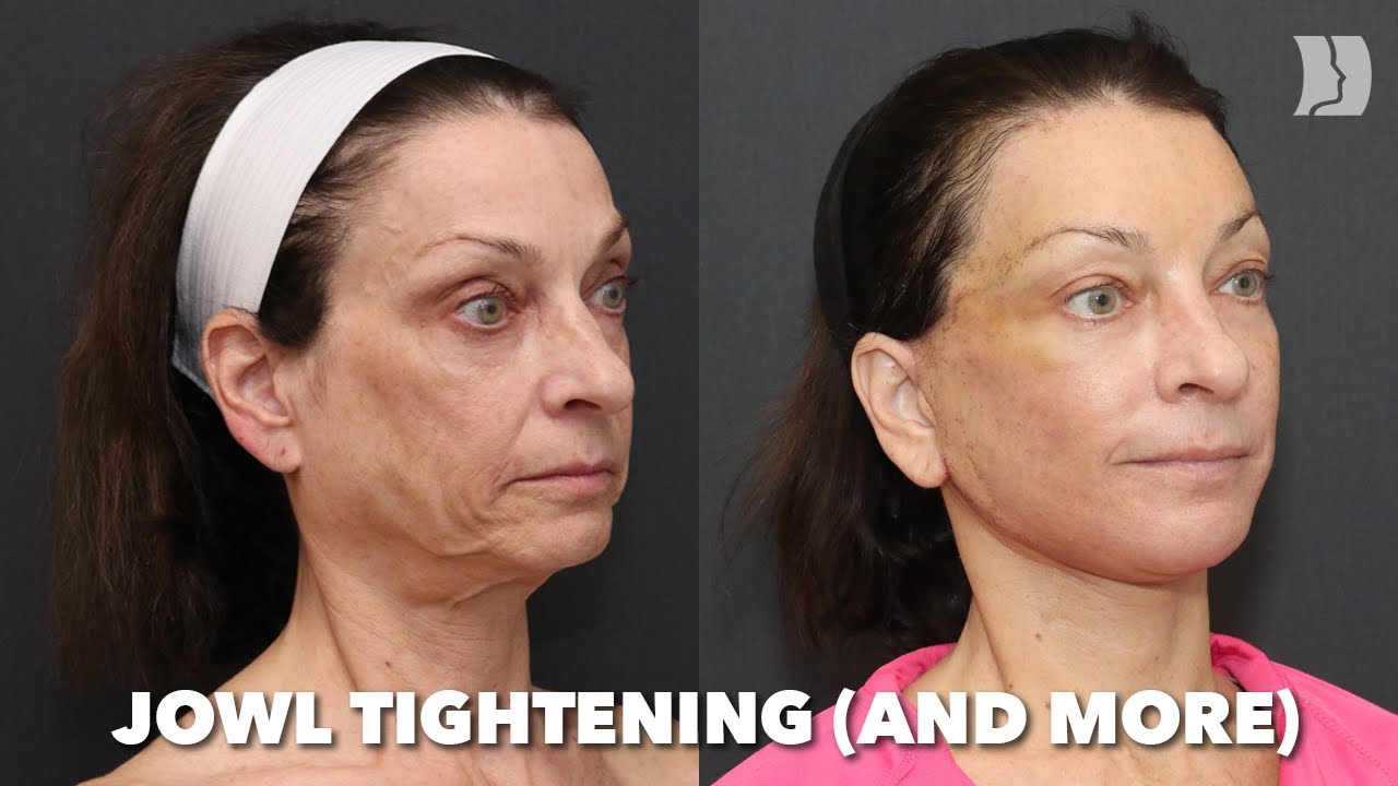 60 Year Old with Skin Jowl Looseness – AMAZING RESULTS