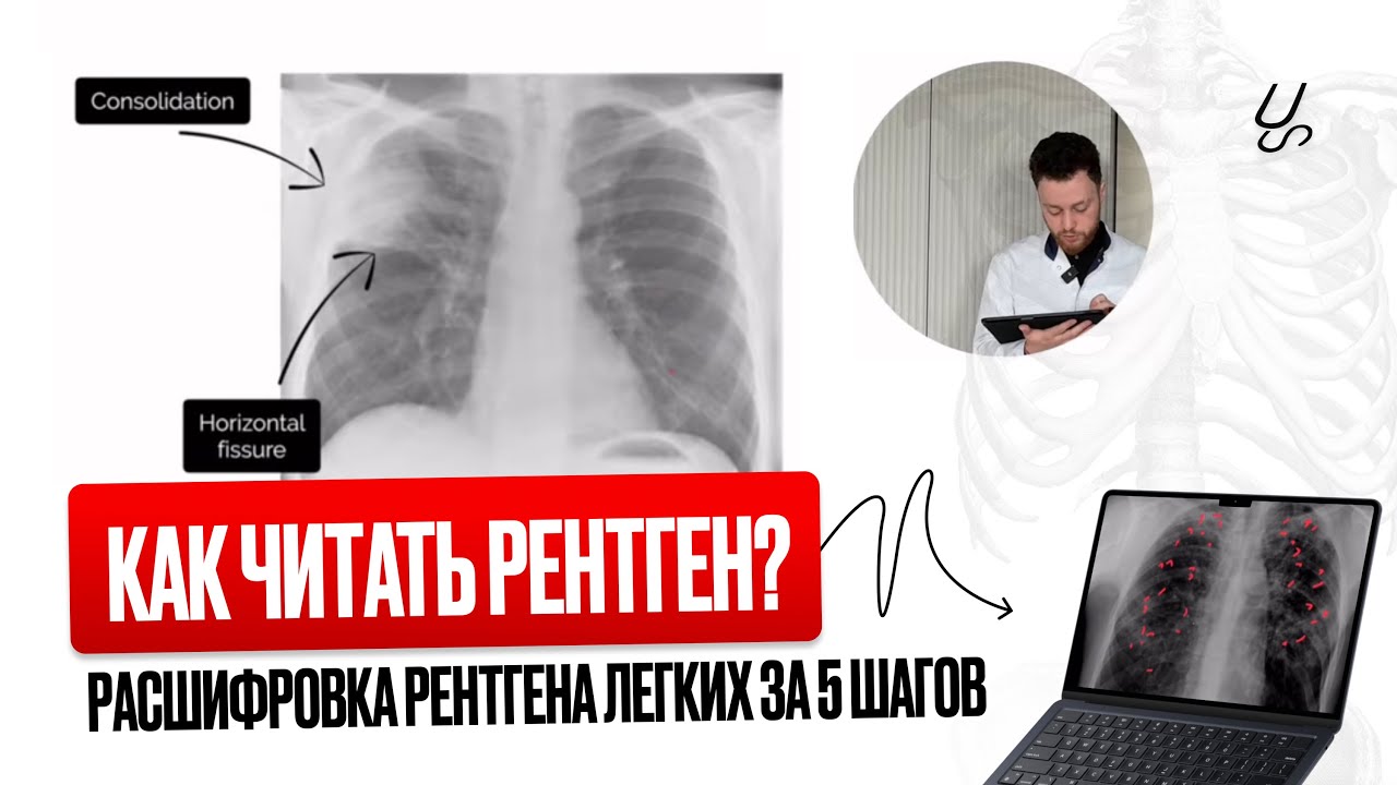 5 простых шагов для чтения рентгена легких