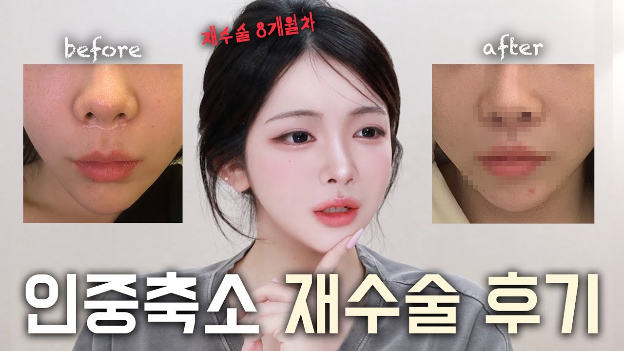눈물나는 인중축소 재수술 후기...✨돈 2배 날린 사람이 되....ㅠ😱 수술흉터? 콧구멍들림? 만족도? 병원고르는 방법?