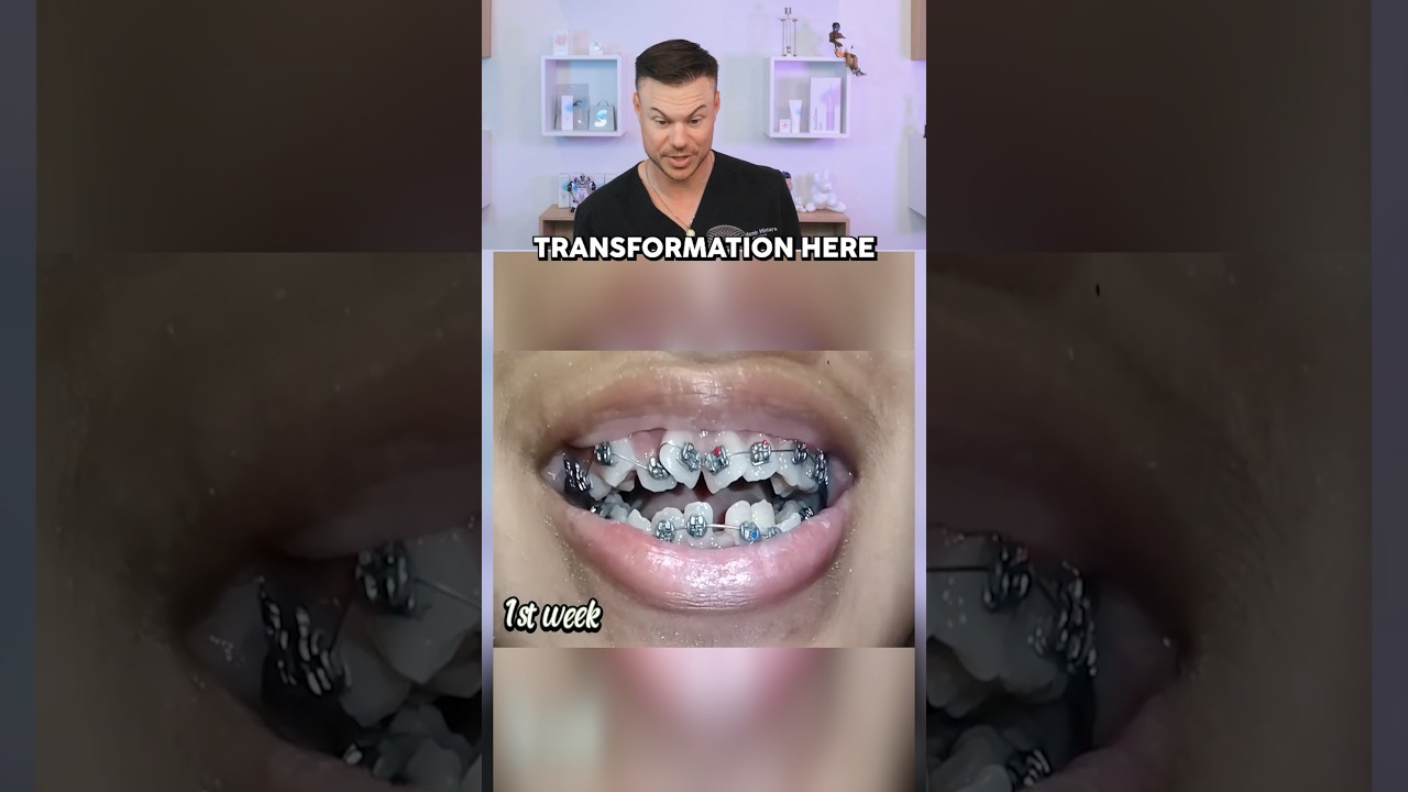 This 1 Year Braces Transformation Is CRAZY! 😮🦷
