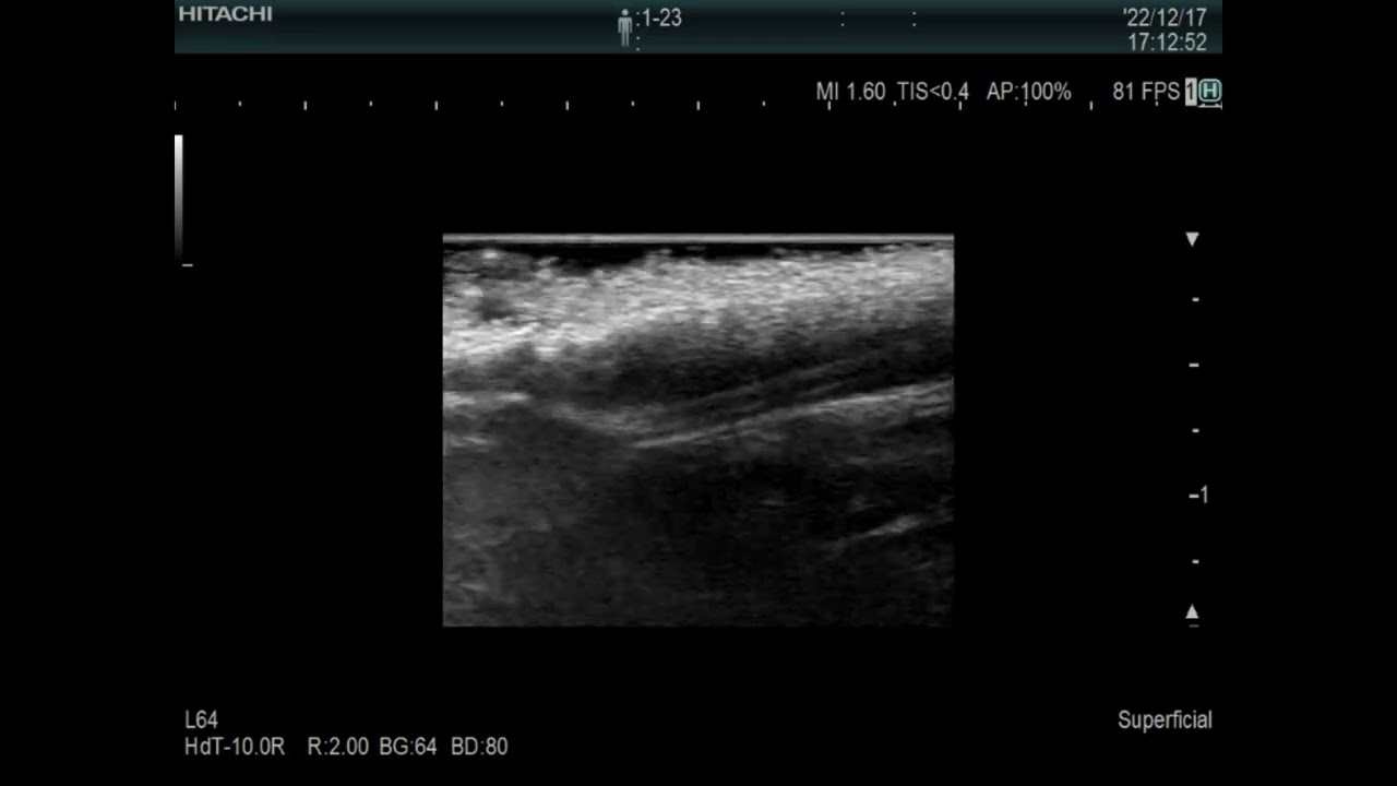 Echo image of the intravascular catheter in the dog's cephalic vein（犬の撓側皮静脈のなかのカテーテルのエコー）