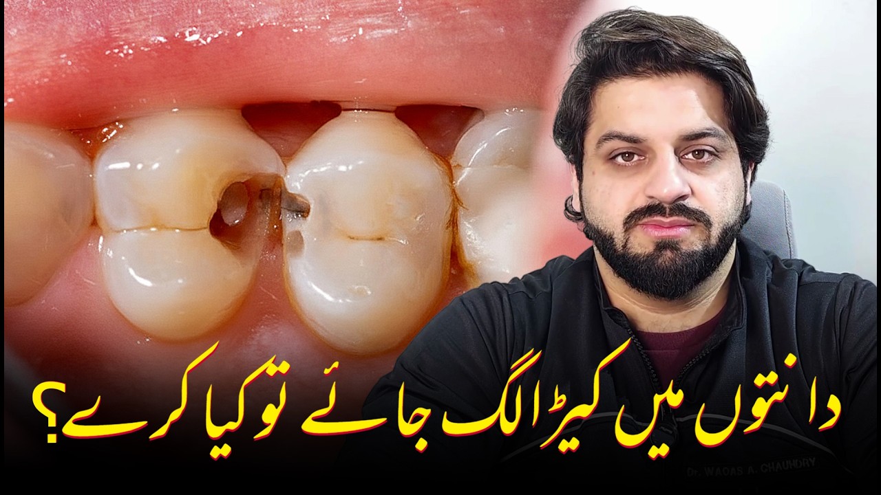 DANTO MAIN KIRA LAG JAYE TU KIYA KARE - DENTAL CAVITY TIPS