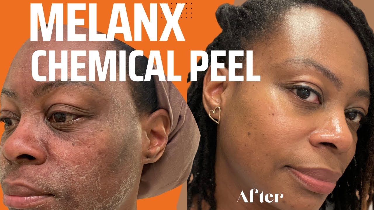 MelanX Chemical Peel review | Peel to to get rid of Hyperpigmentation | Look more youthful