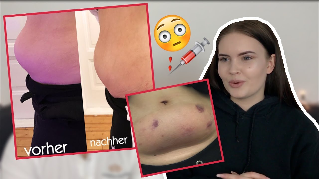 OMG! Ich habe es getan! - FETT-WEG-SPRITZE 😳💉