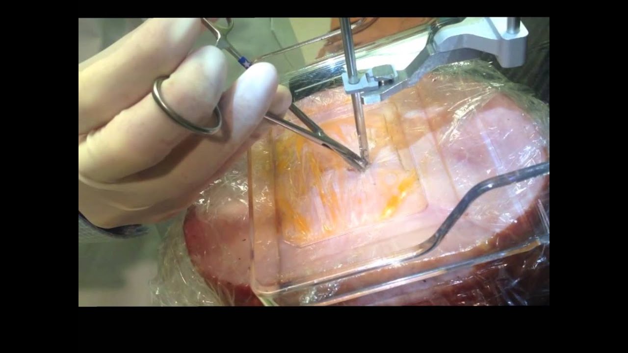 tomo biopsy movie