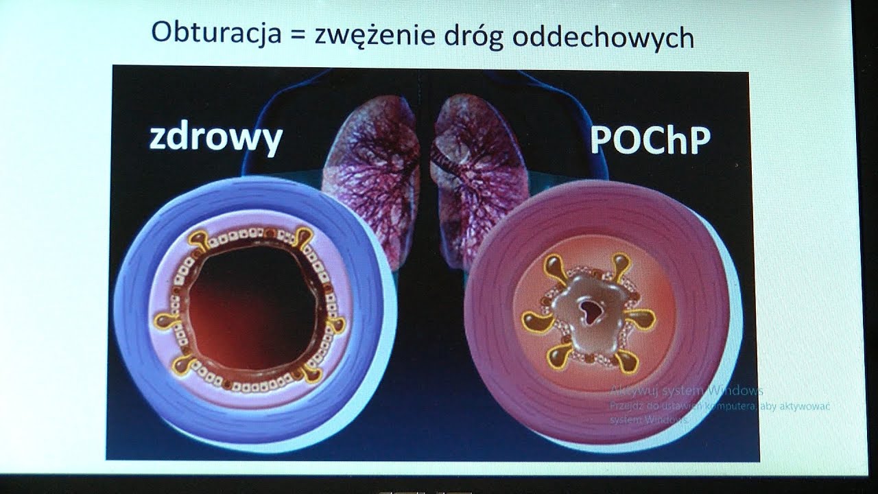 POChP stanie się trzecią przyczyną zgon&oacute;w na świecie?