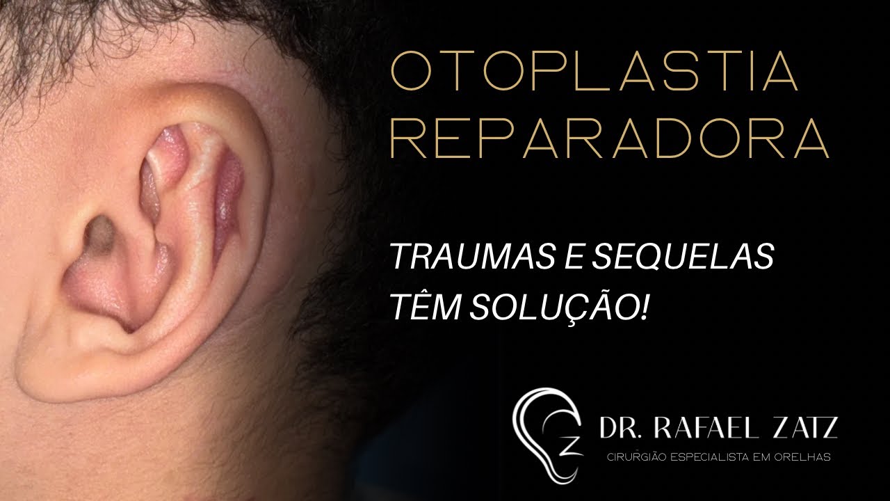 Otoplastia reparadora: entenda como é essa cirurgia.