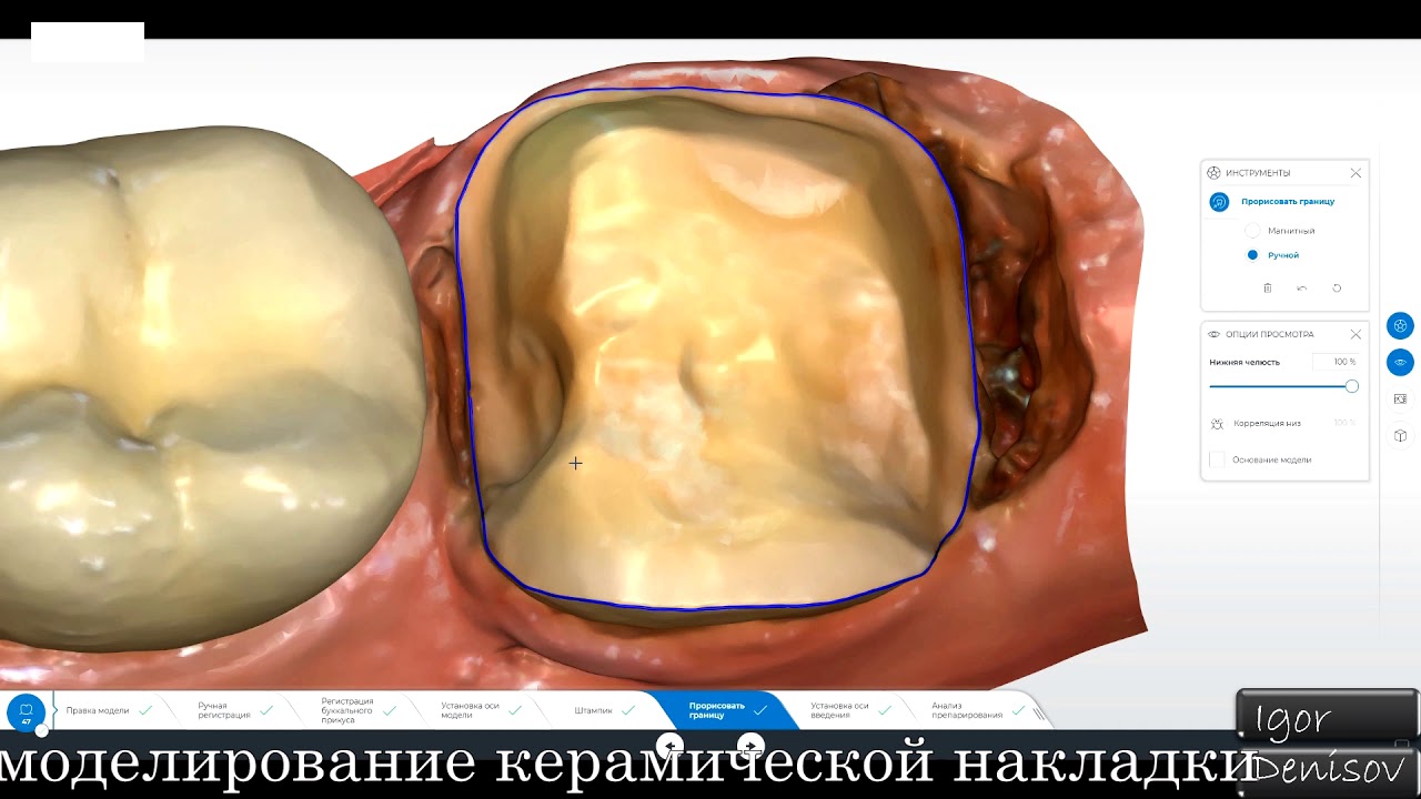Керамическая накладка CEREC (Игорь Денисов)