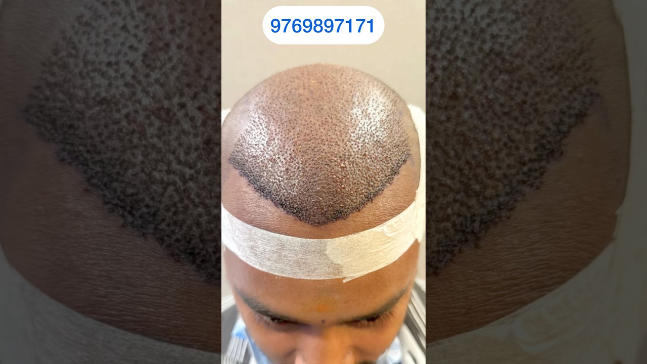 Covering full area by DHI method hair transplant