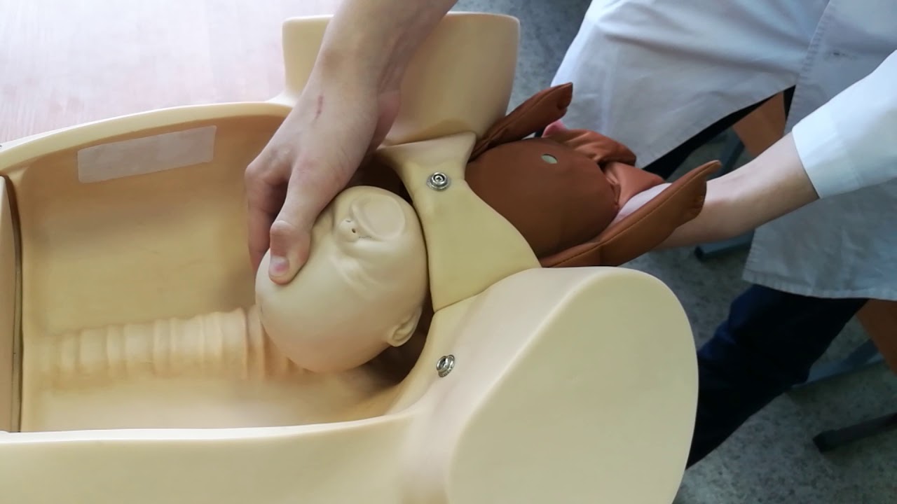 Оказание помощи при выведении головки в заднем виде тазового предлежания