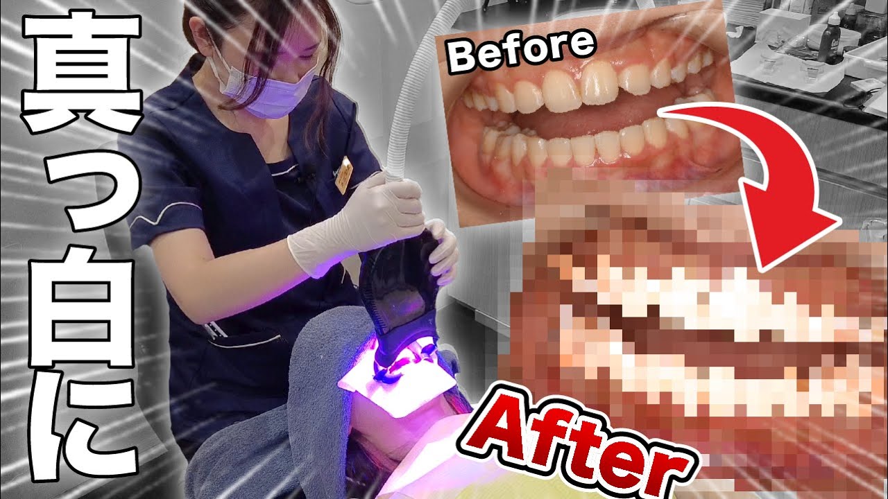 【ホワイトニング】治療風景を全部お見せします！気になる疑問にも徹底回答！【オフィスホワイトニング、痛み、治療時間、ポリリン酸】