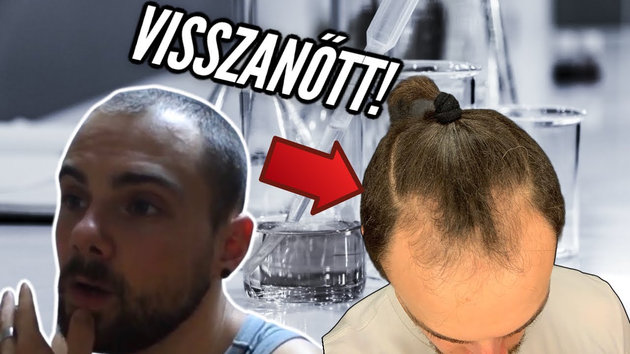 Hajhullás ellen! - Így állítottam meg és fordítottam vissza a kopaszodást!!!