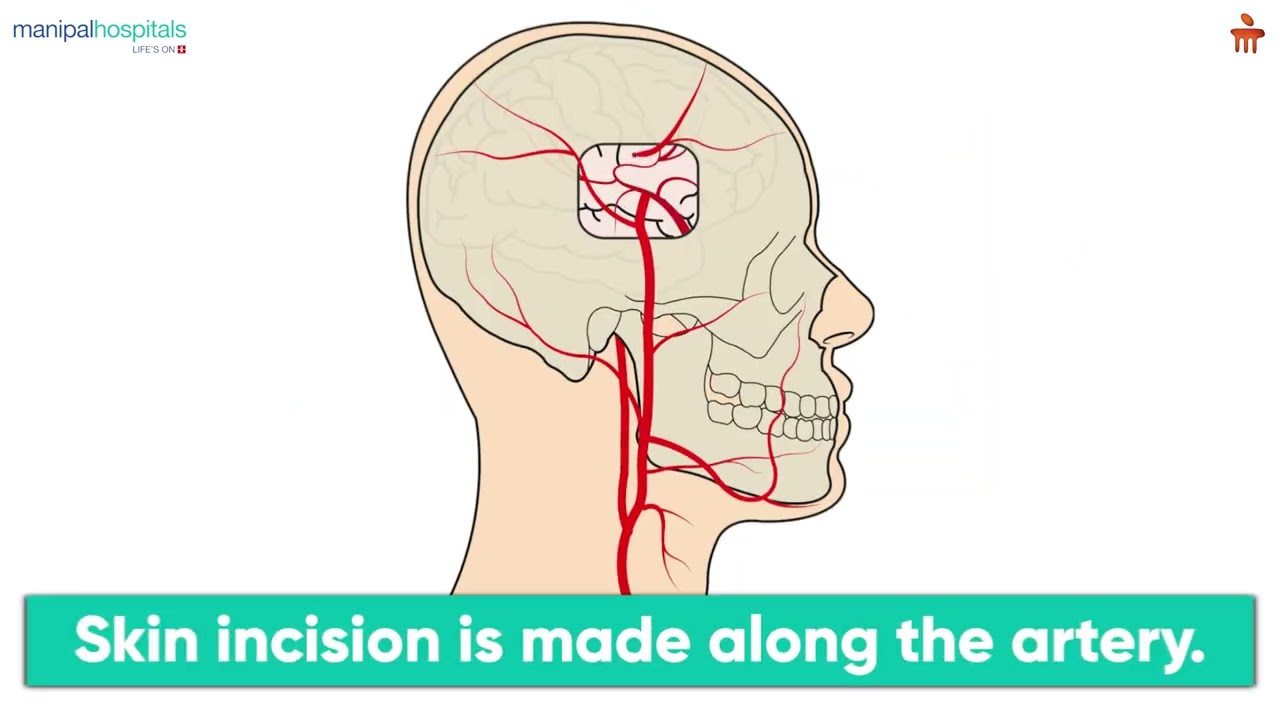 Life-Saving Brain Bypass Surgery Explained | Step-by-Step Guide to STA&ndash;MCA Bypass & Recovery