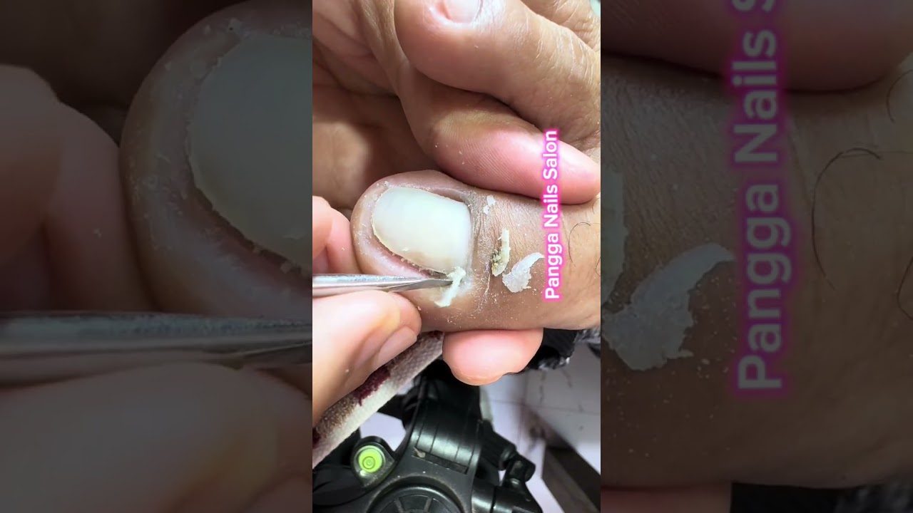 Ingrown and dry skin removal