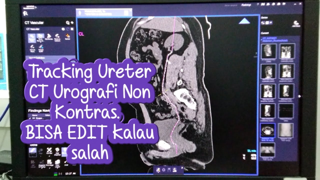 Tracking Ureter Pakai Vessel Definition di Syngo.via - BISA di EDIT Kalau Salah Tracking