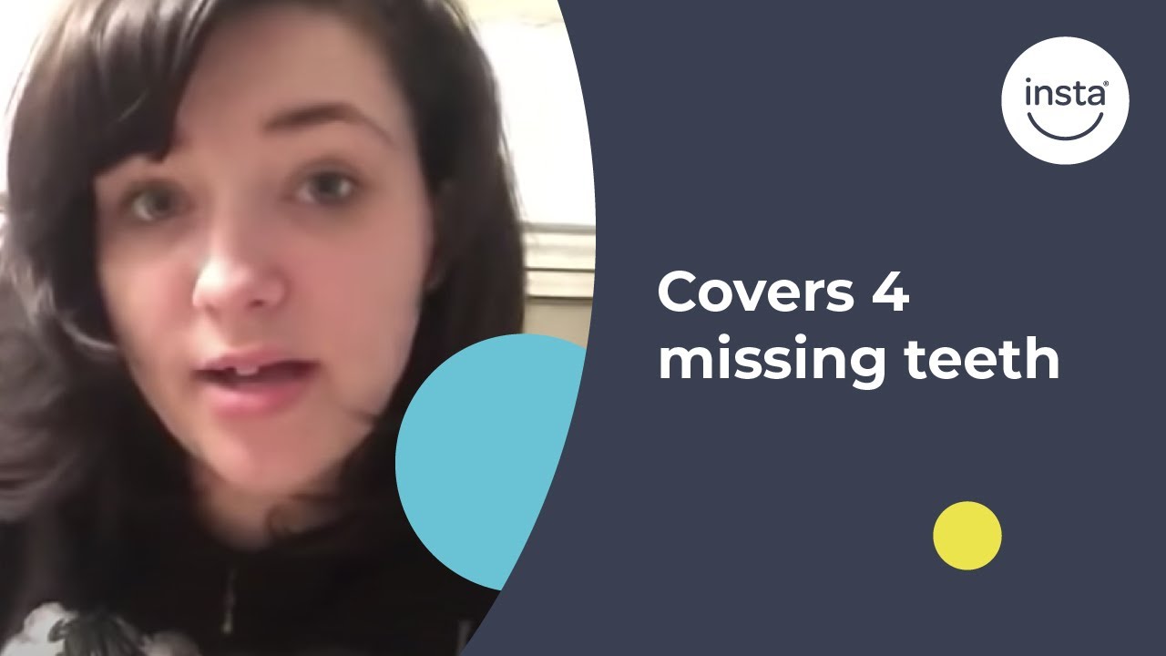 Tabetha's Story: Covering 4 Missing Teeth | Instasmile Review