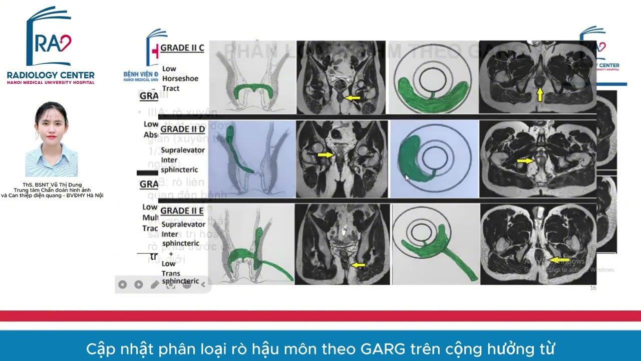 CẬP NHẬT PHÂN LOẠI RÒ HẬU MÔN THEO GARG TRÊN CỘNG HƯỞNG TỪ