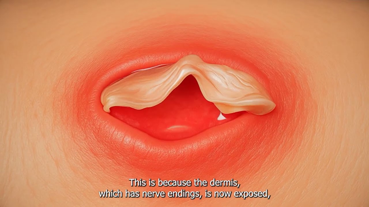 Pressure Ulcer Staging Explained | Stage 1 & 2 Pressure Injuries (Nursing & Medical Students Guide)