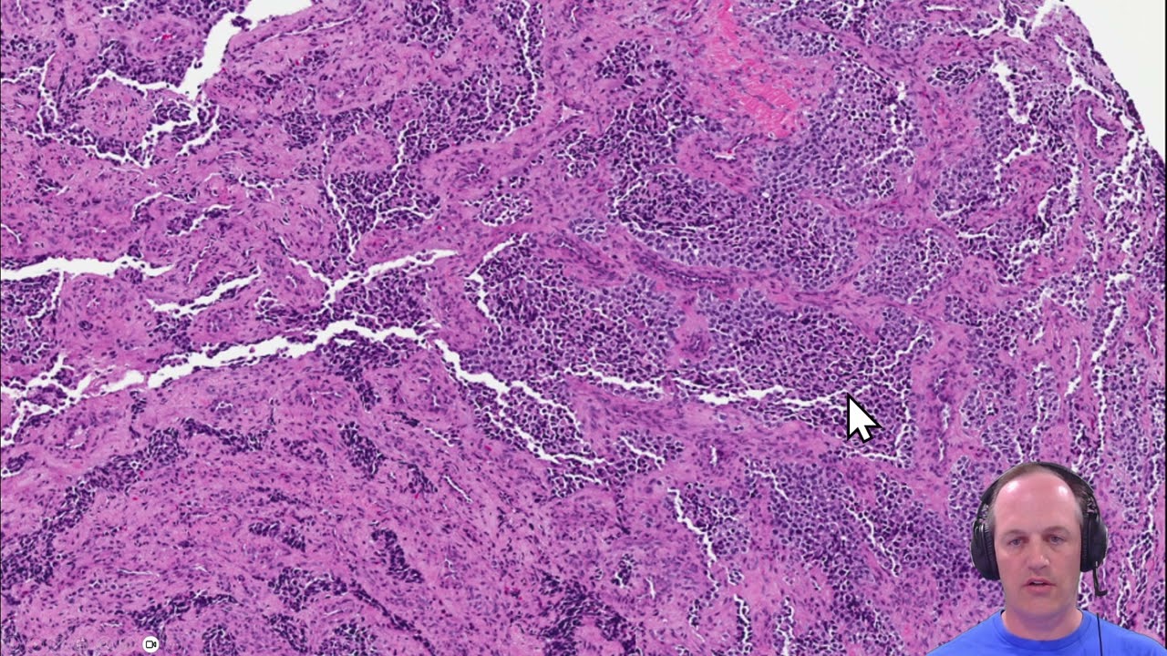 Guide to Pediatric Small Round Blue Cell Tumors - Alveolar Rhabdomyosarcoma