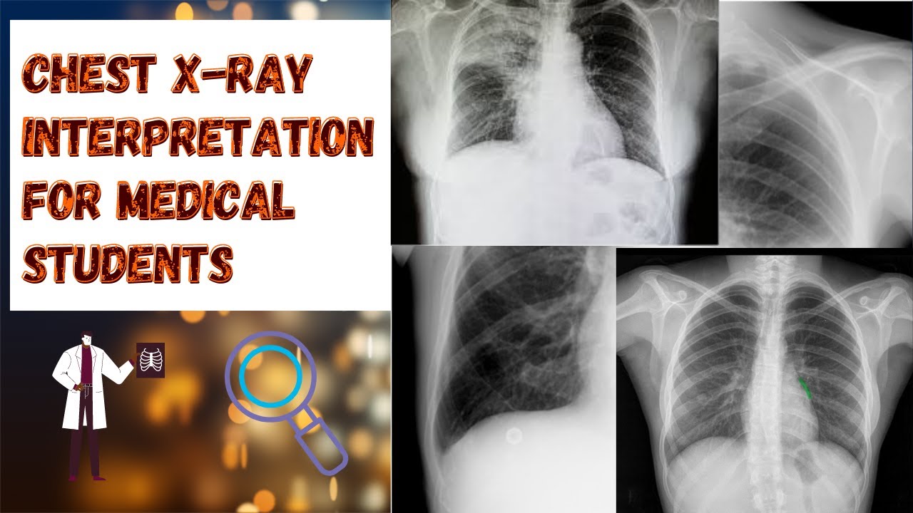 Chest X-Ray Interpretation for Medical Students | ABCDE approach
