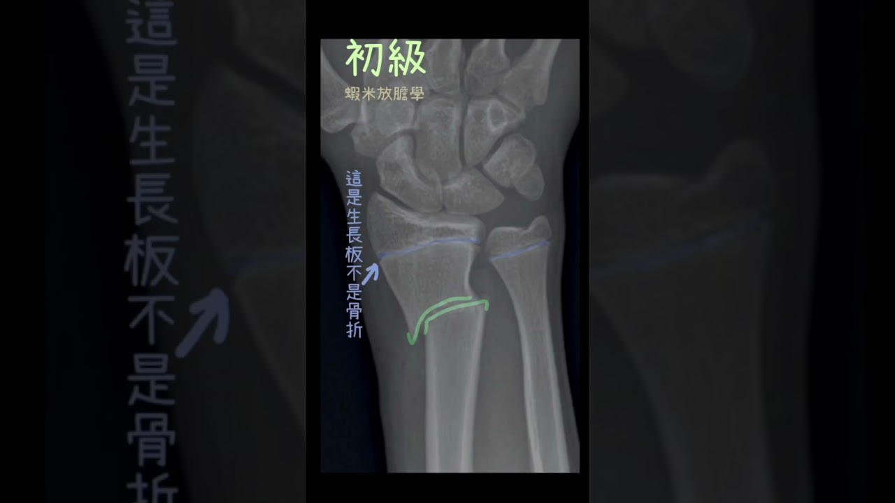 骨折X光醫學影像｜X ray fracture #xray