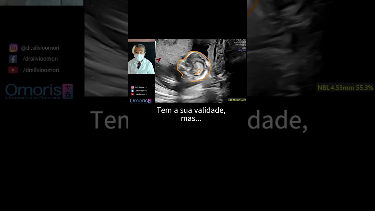 Gravidez 15 semanas - Osso nasal #gestante #gravidez #bebe #ultrassom