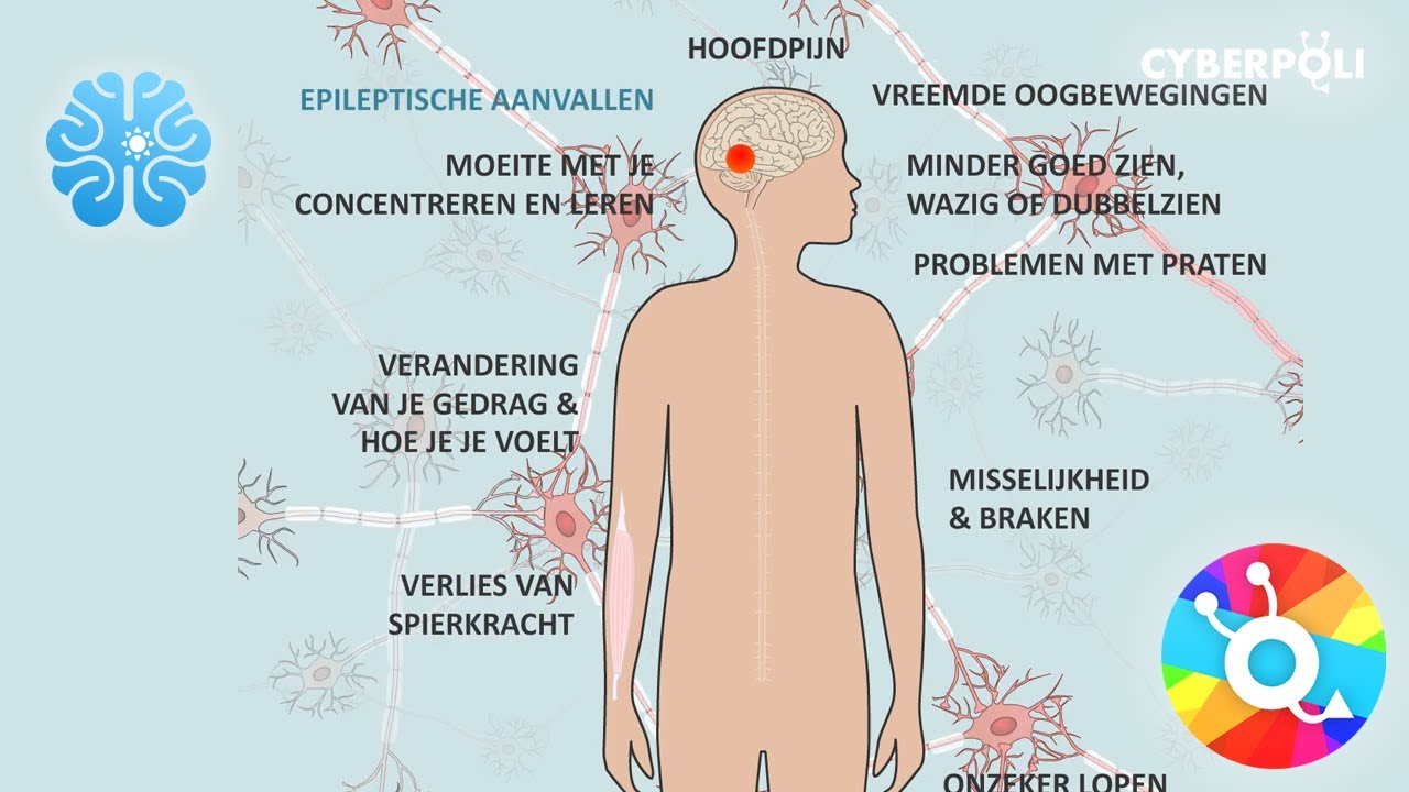 Hersentumoren: Waar kun je last van hebben?