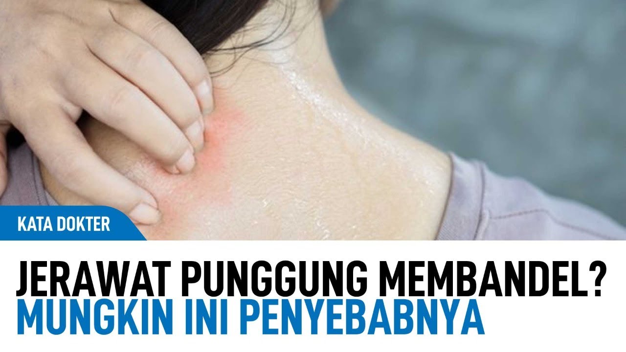 Cara Mengatasi Jerawat di Punggung Dari Dokter Kulit | Kata Dokter