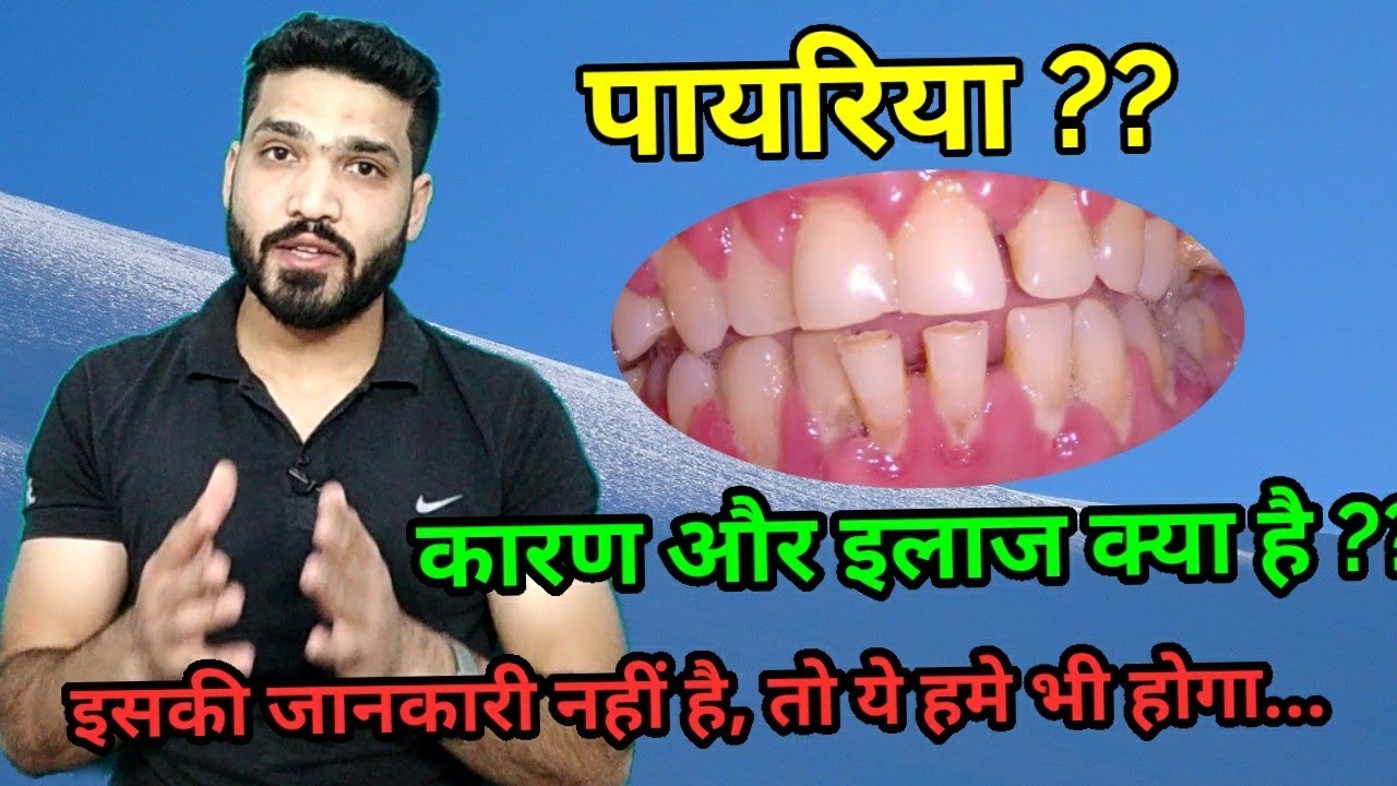 पायरिया क्या है ?? इसके कारण, लक्षण और इलाज । pyriya , periodontitis causes, symptoms & treatment