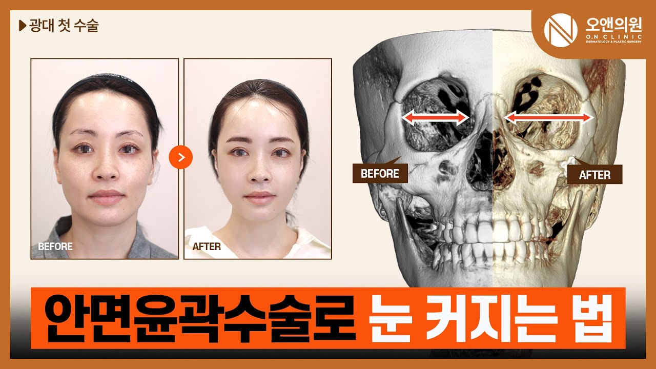 안면윤곽수술로 눈 커지는 법, 광대 첫수술 | (JPN/CN/ENG SUB) #윤곽 #중안면축소수술 #광대비대칭 #성형