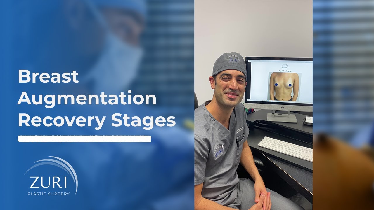Breast Augmentation Recovery Stages