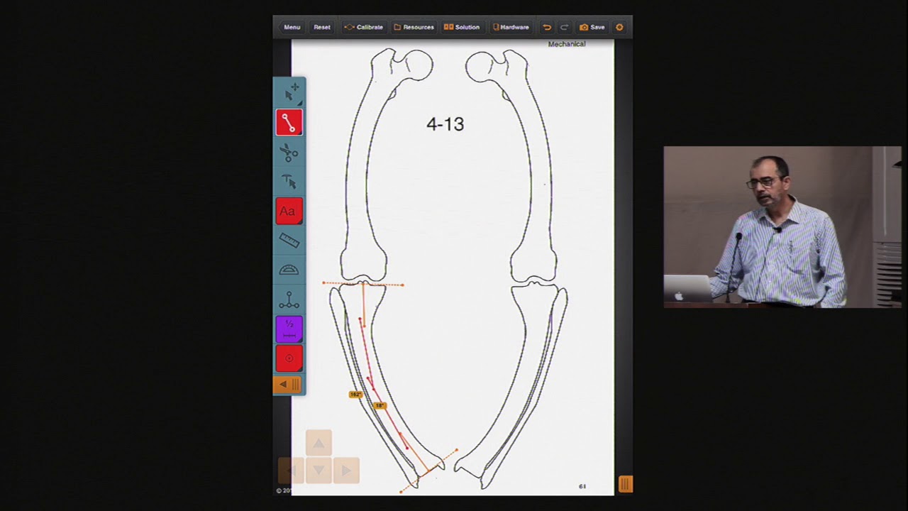 Multiapical (bowing) deformity