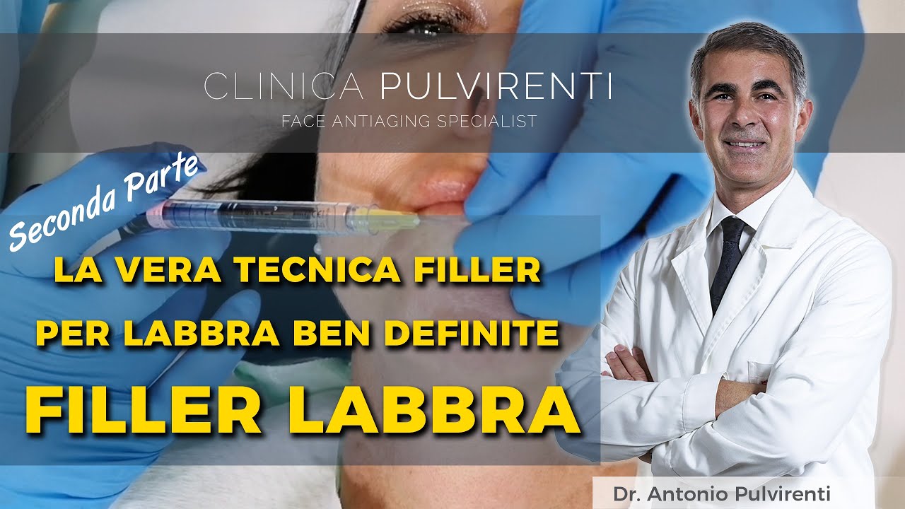 [Seconda Parte] La Tecnica di FILLER LABBRA del Dr. ANTONIO PULVIRENTI, Giarre, Catania.