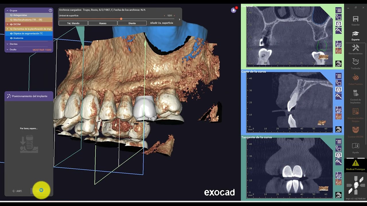 CERIK3D - video 2-  VIVO Curso Guía Quirúrgicas 3D en EXOCAD- Tutorial- AREA3D COS 2023